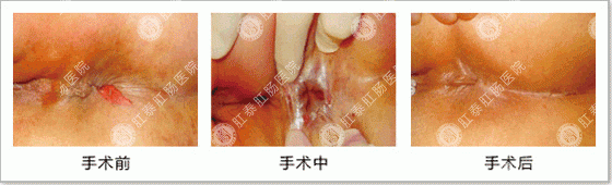 肛泰方法治肛裂过程