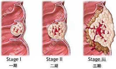 直肠恶变的症状 早期直肠恶变的临床特征主要为便血和排便习惯改变