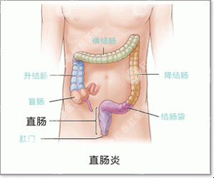 福州医博肛肠医院有限公司





：得了急性肠炎怎么办？