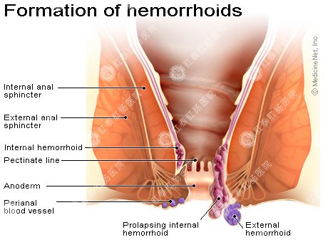 痔疮