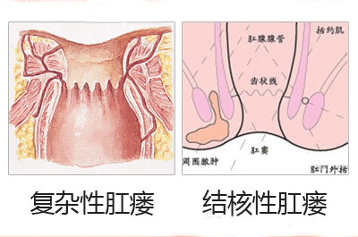 肛瘘